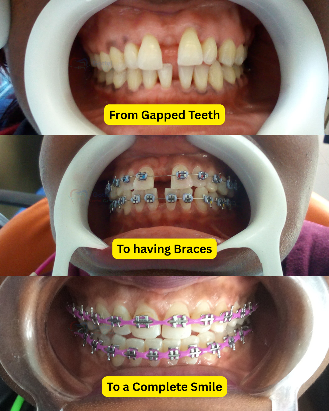 Braces transformation main